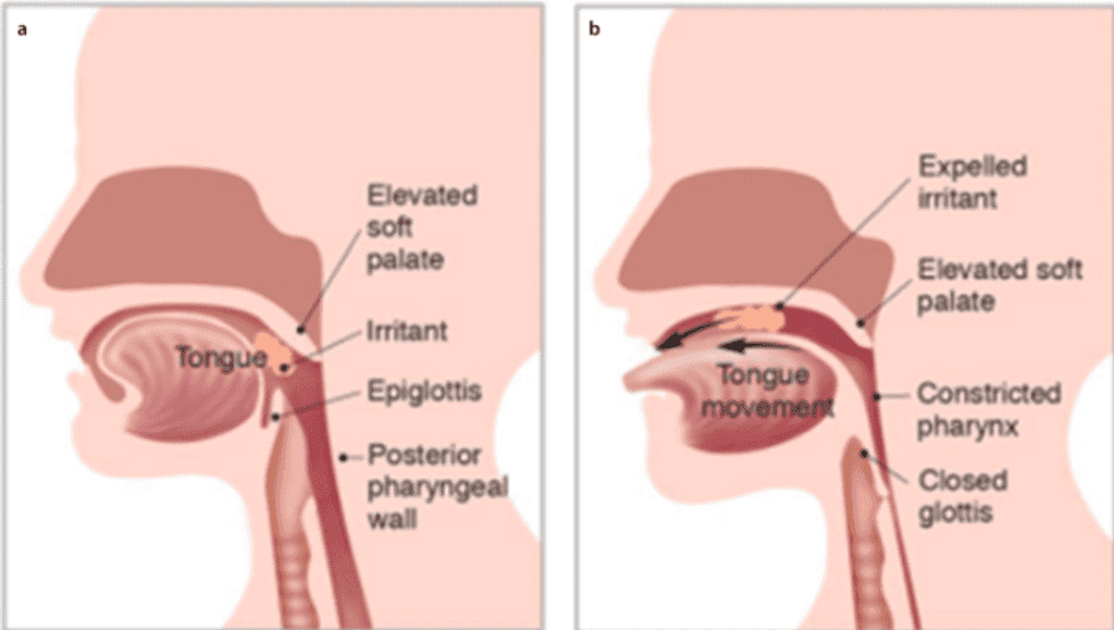 baby's gag reflex is located about a third of the way in on the tongue and gagging on solid foods is a reverse swallow (shown here)