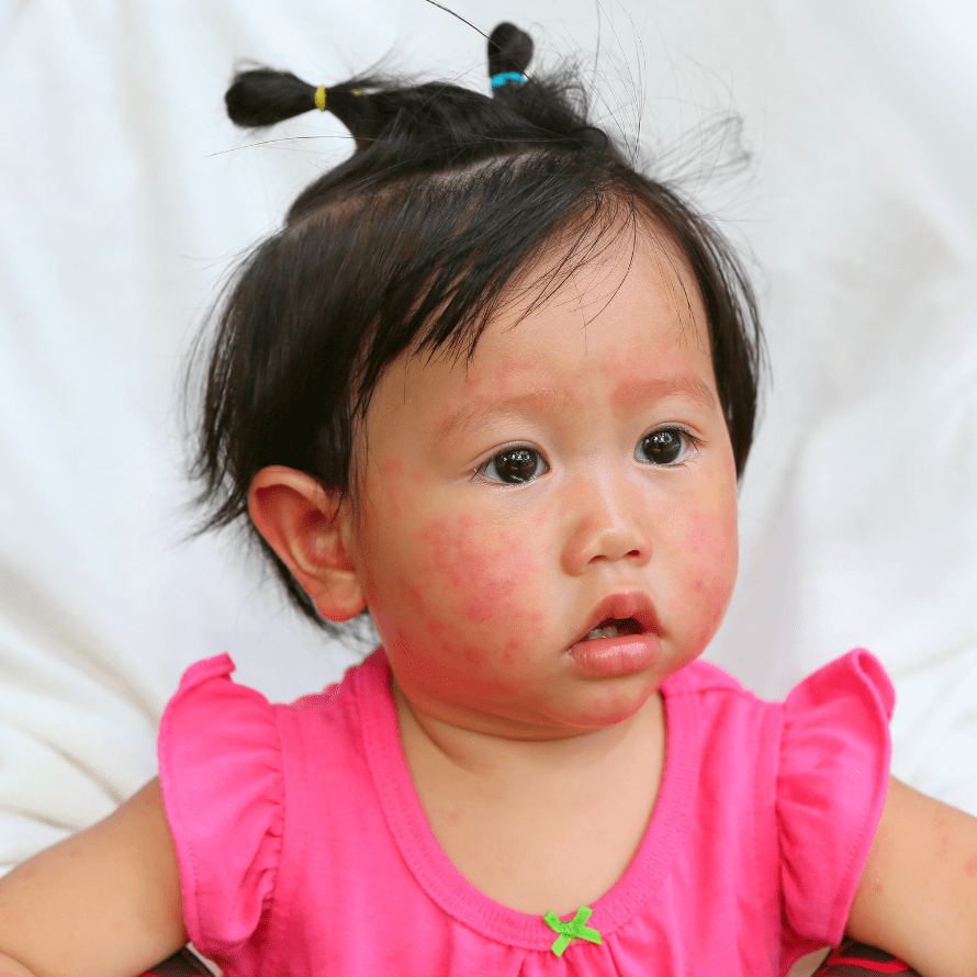Baby showing signs of a reaction to an allergen, with a rash spreading across their face.