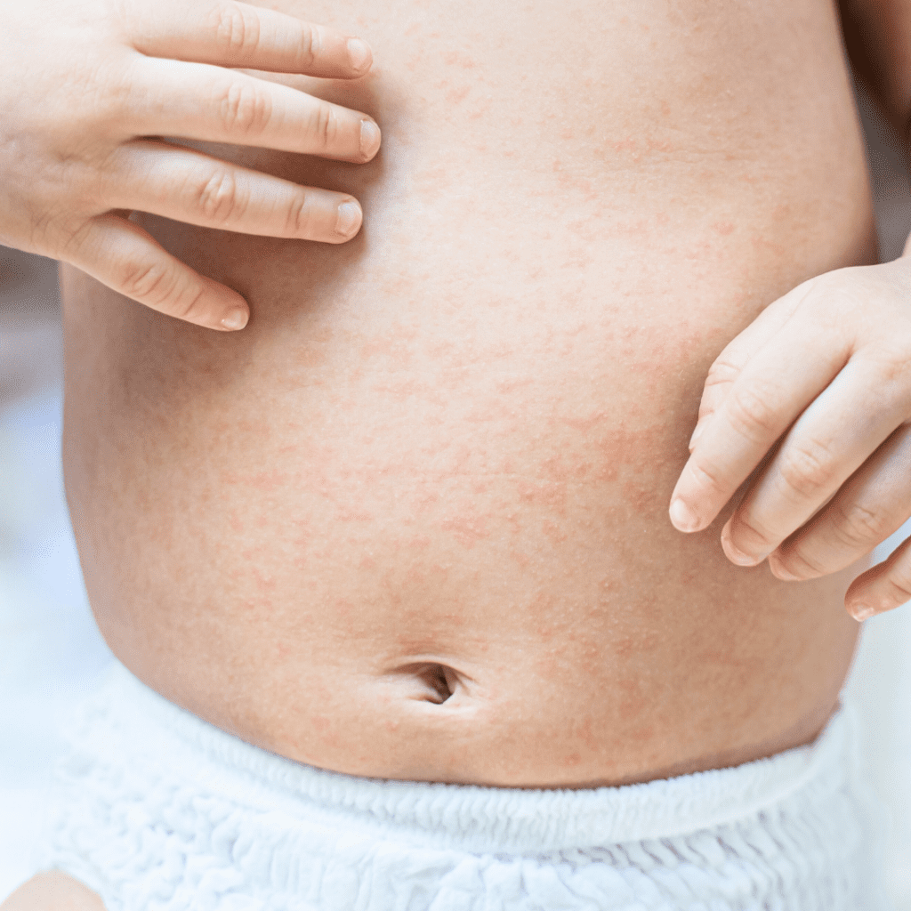 Hives on a baby's stomach to show a possible allergic reaction.