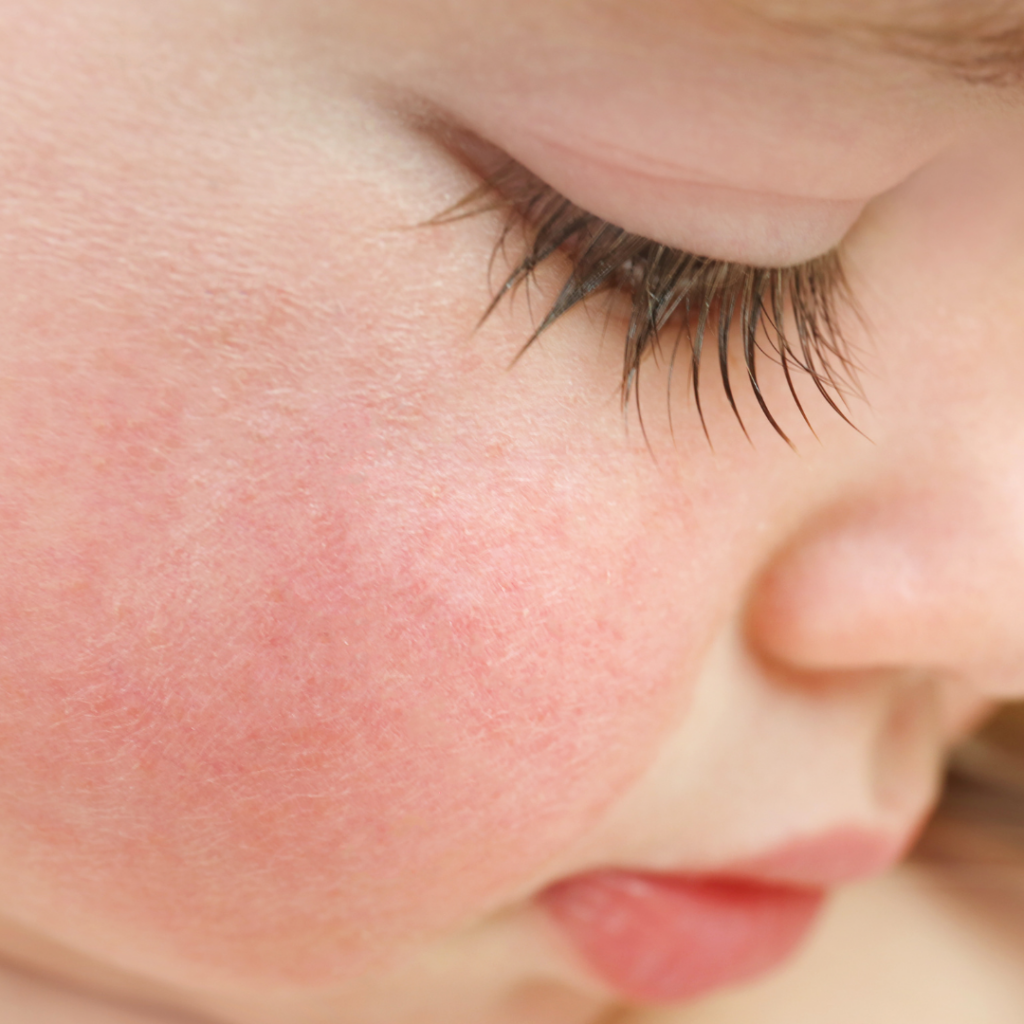 Close up of a baby's cheeks that are very red from the cold.