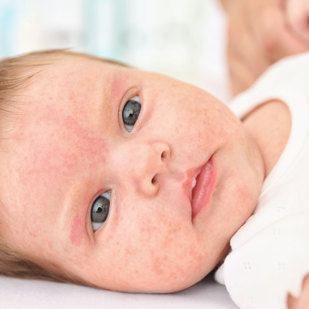 A baby with a rash on their face from an allergic reaction.