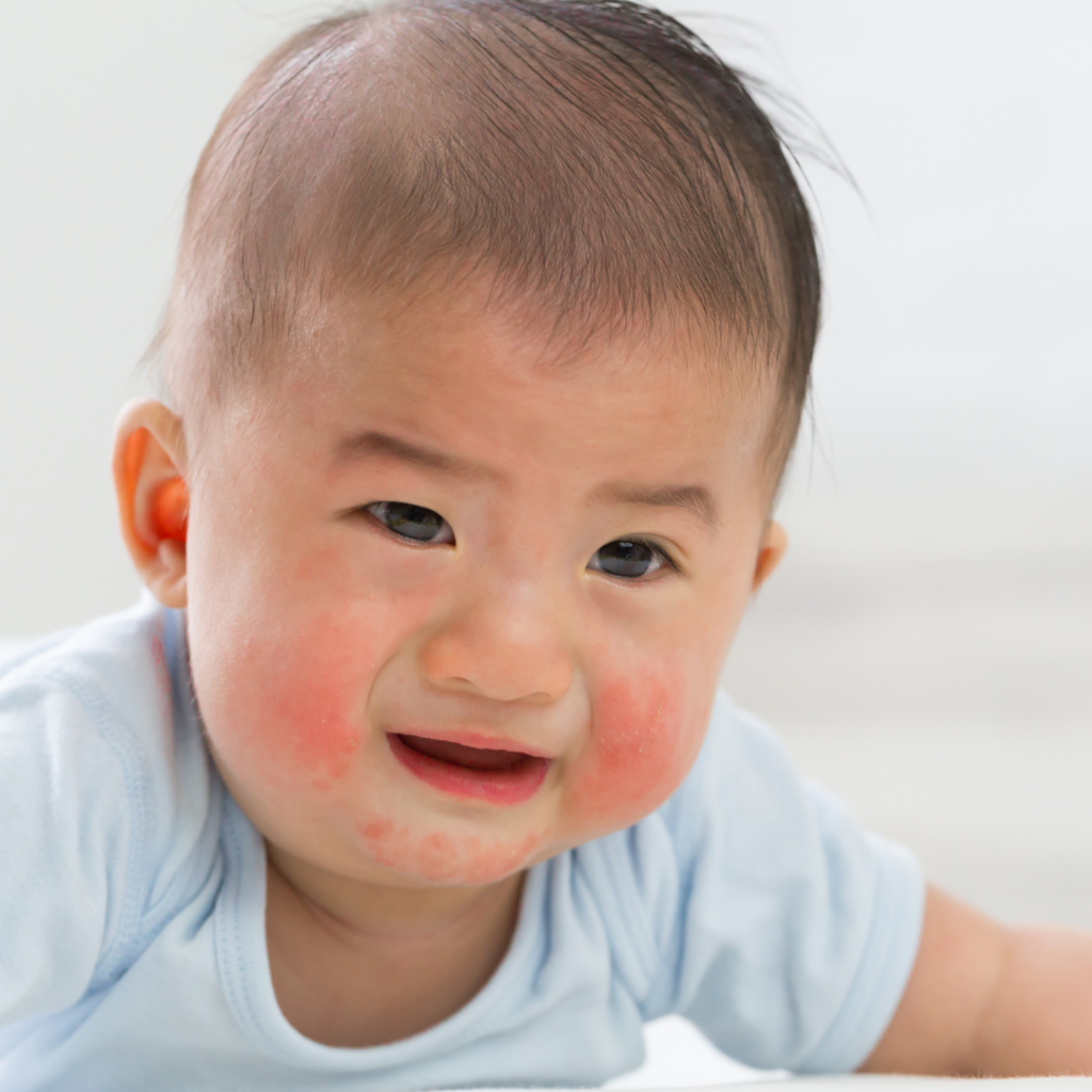 A baby with a red rash on their cheeks.