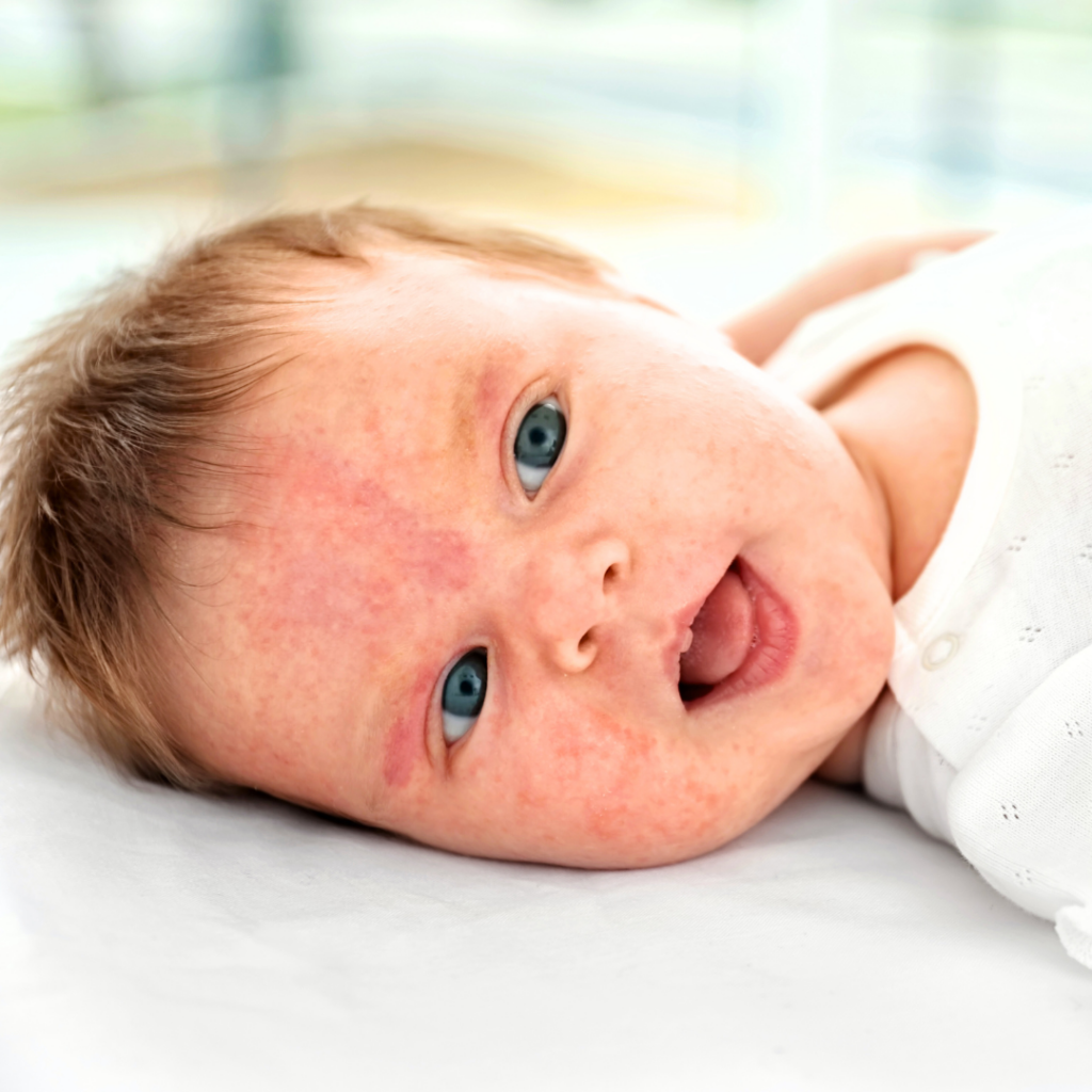 A baby with a rash on their face from eating a potentially allergenic food during baby led weaning.