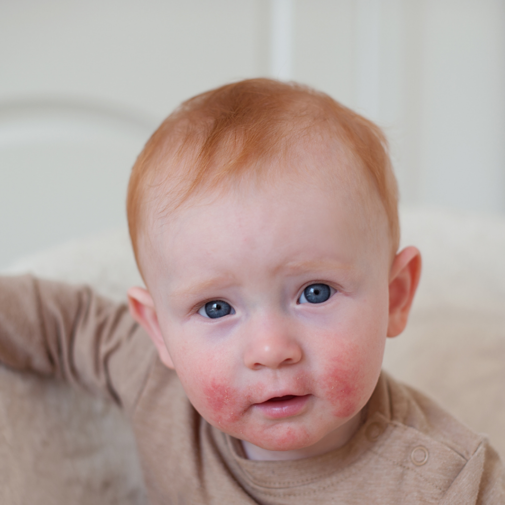 Red-headed baby with a rash around their mouth.