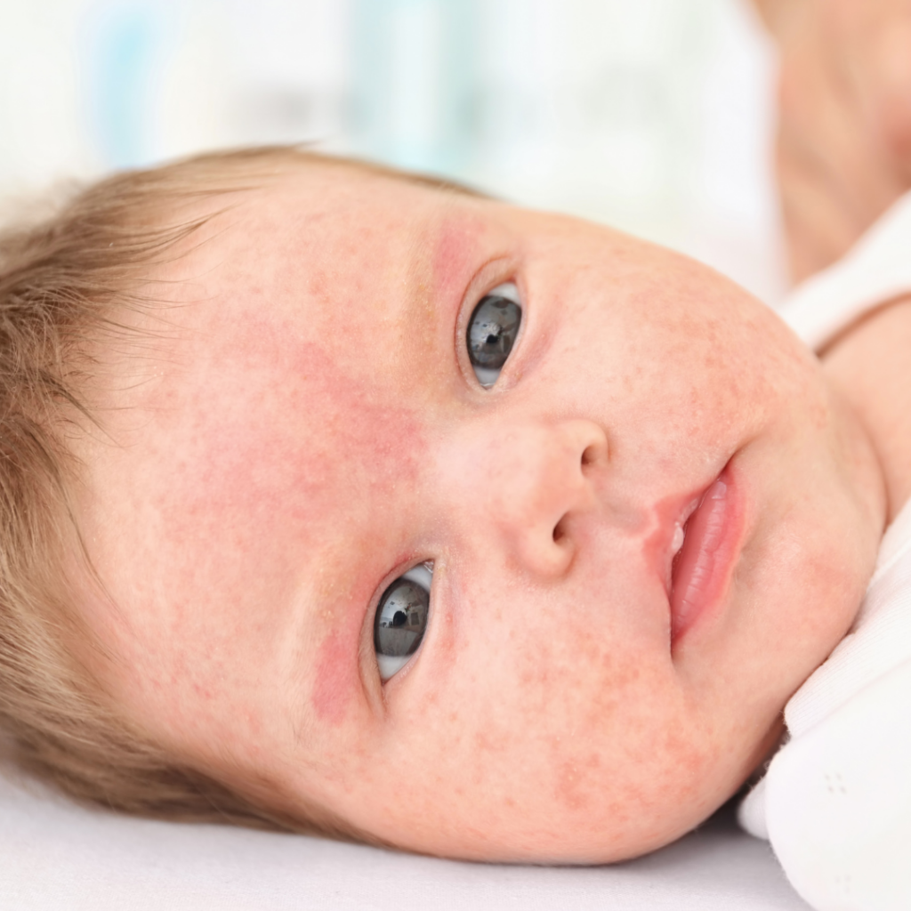 A baby laying down with a rash covering their entire face.