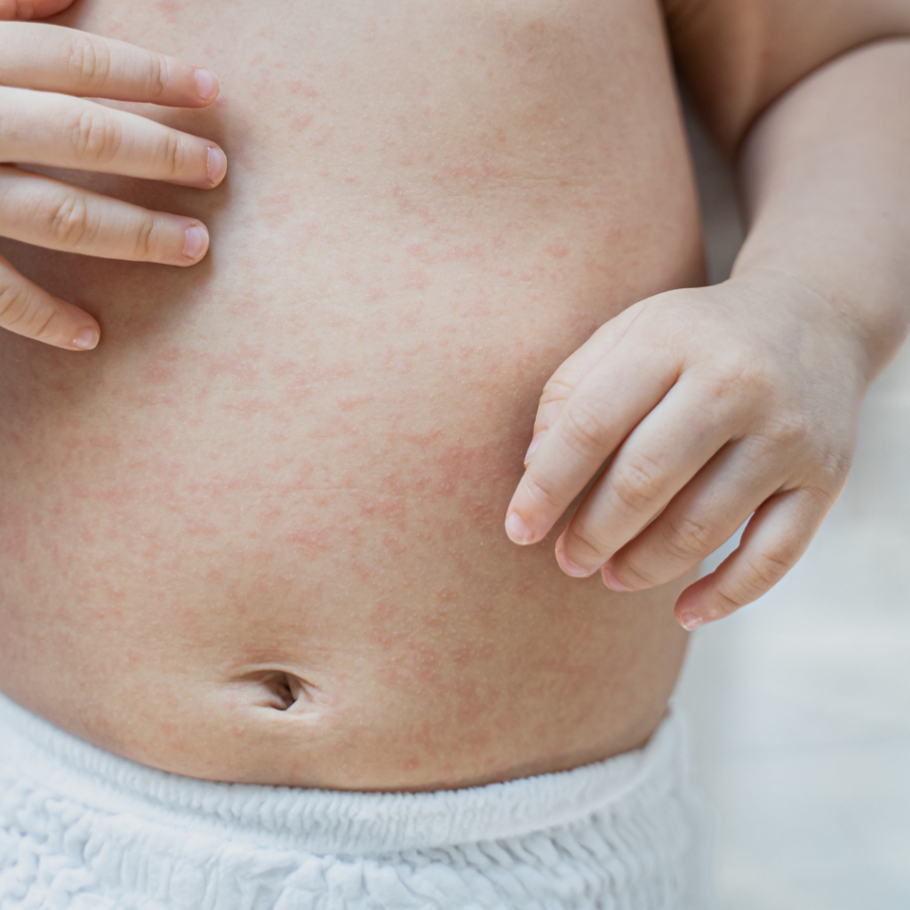 A baby with a rash all over their belly.