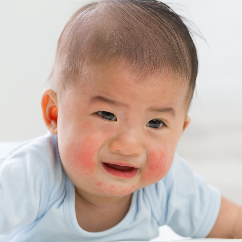 A baby doing tummy time with a red rash on their cheeks and around their mouth.