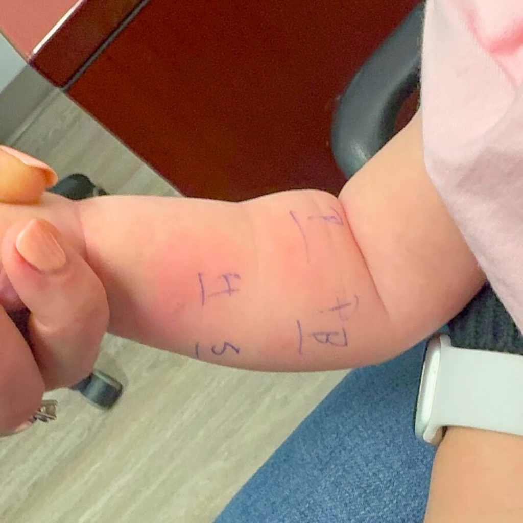 Close-up image of a 6 month old getting a skin prick test done at the allergy clinic.