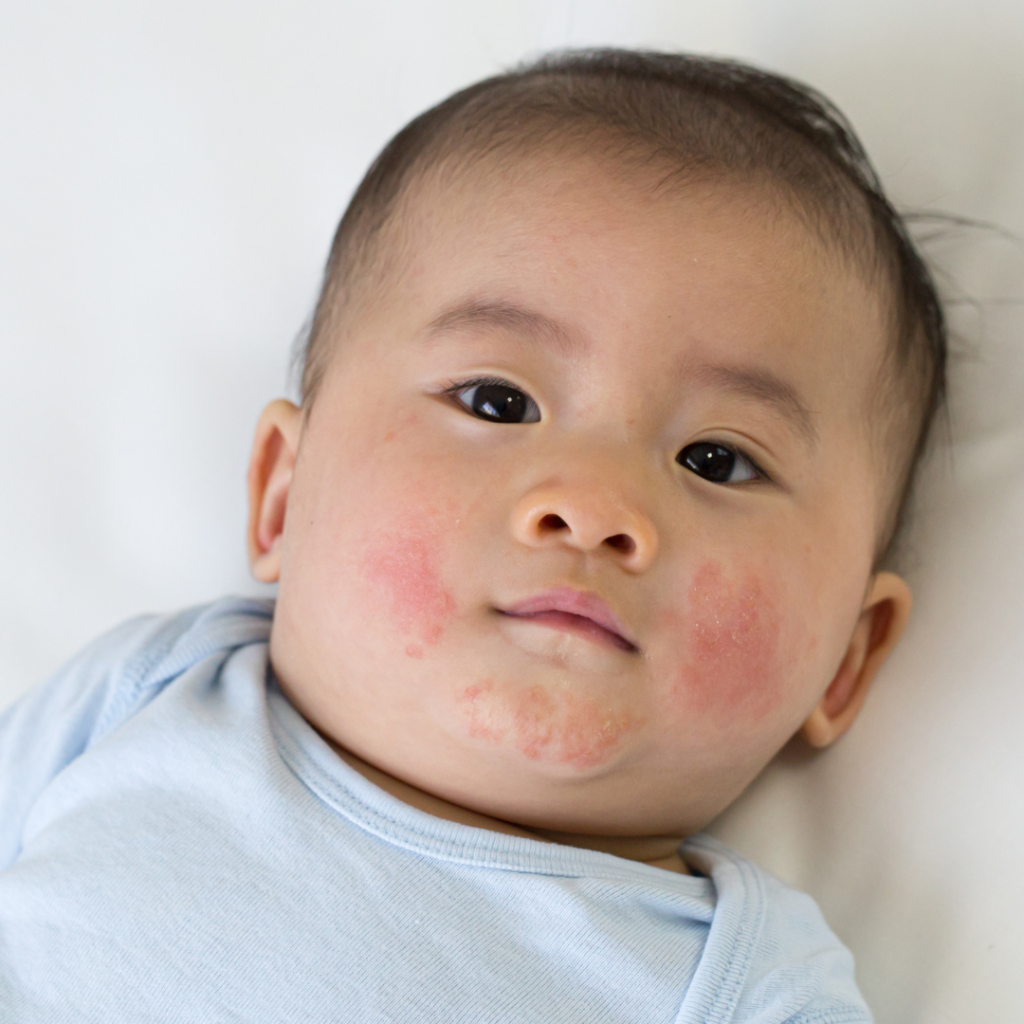 Close-up of a babies face which has a red rash over the cheeks and chin.