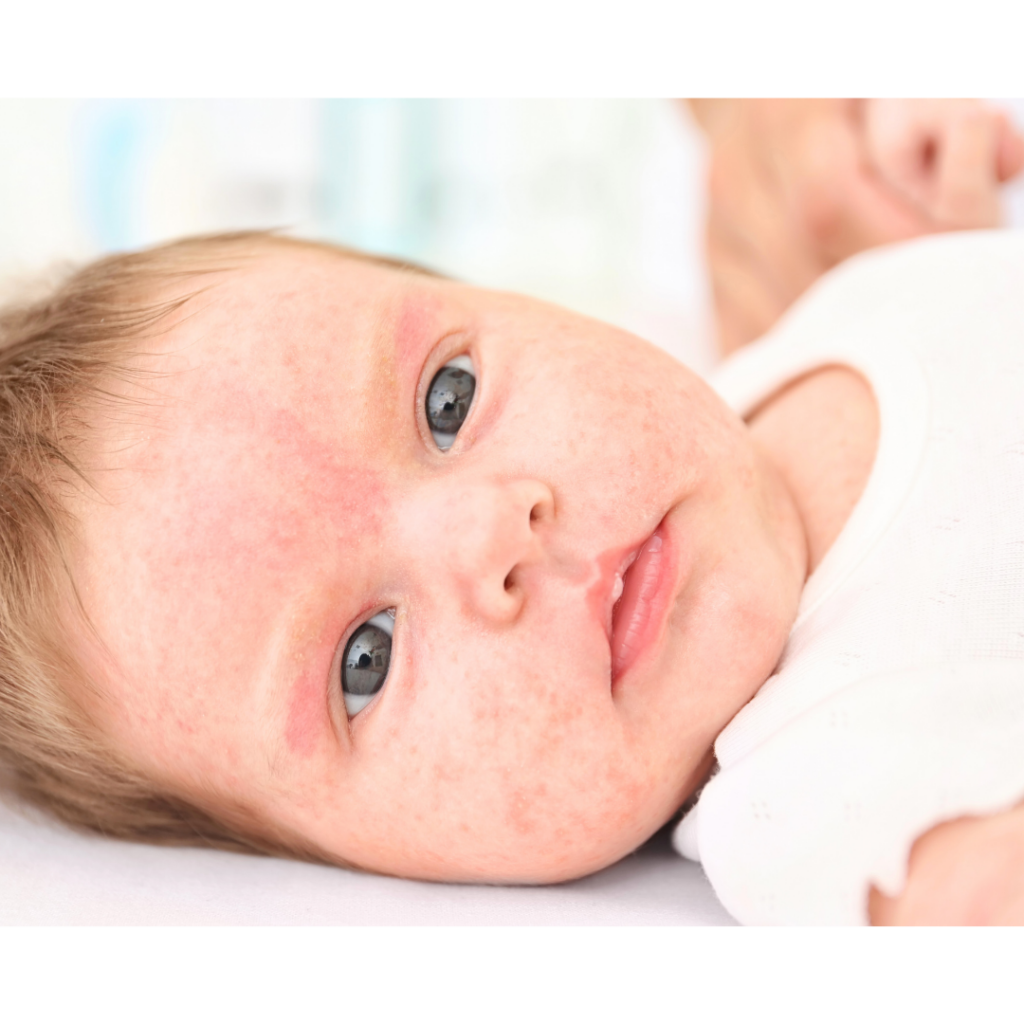 Close-up image of a baby's skin with a mild rash on their face.