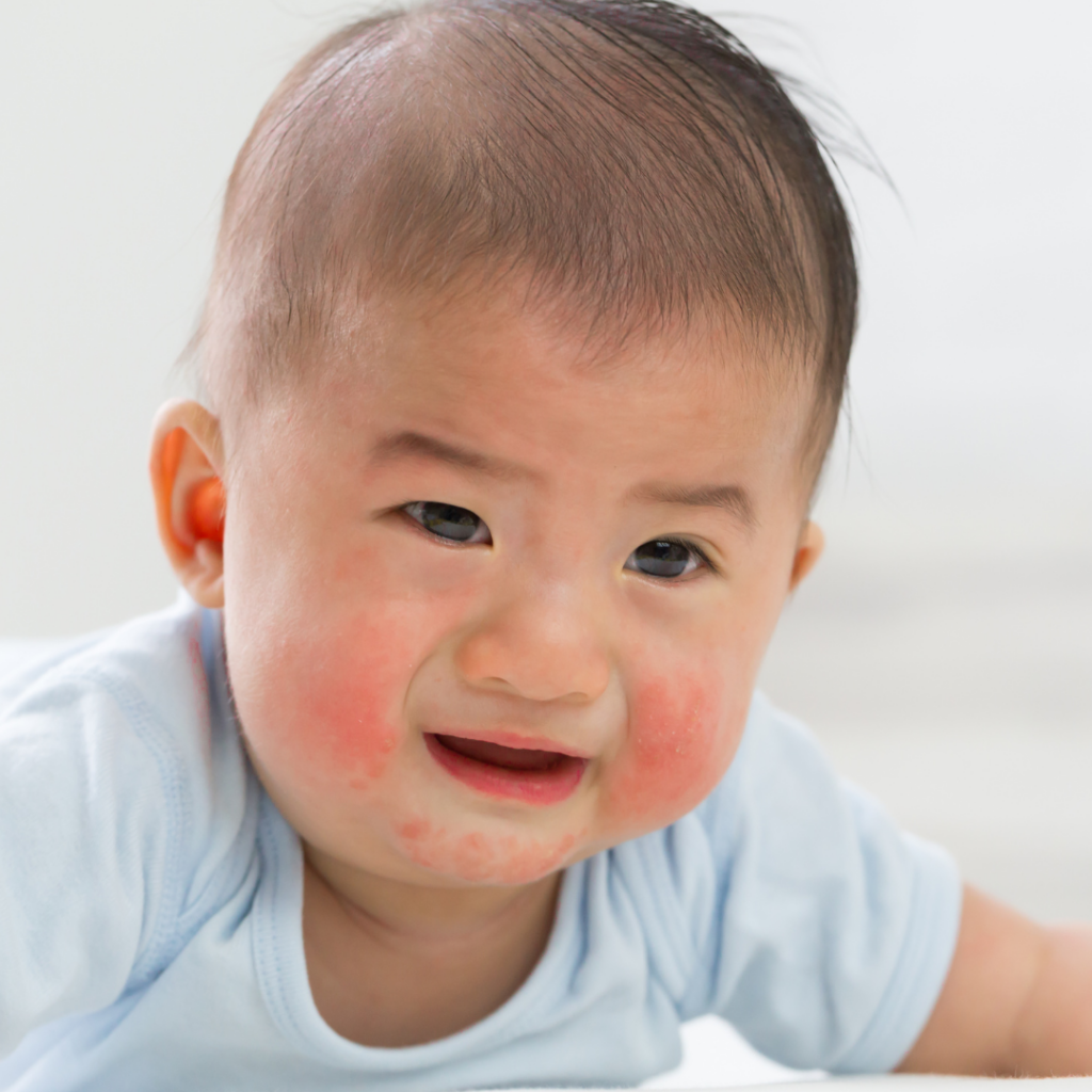 An allergic reaction in the form of a rash after serving the baby rice.