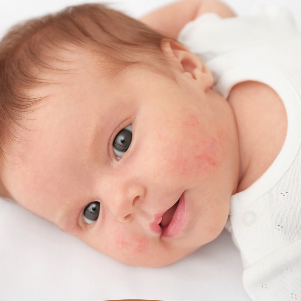 A baby has a red rash on their cheeks.