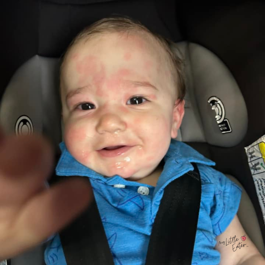 A baby with raised red hives on his face sits in a carseat on the way to seek medical assessment for an allergic reaction.