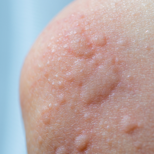 Eela Rashes The research you need to know on introducing eggs to baby as a priority ...