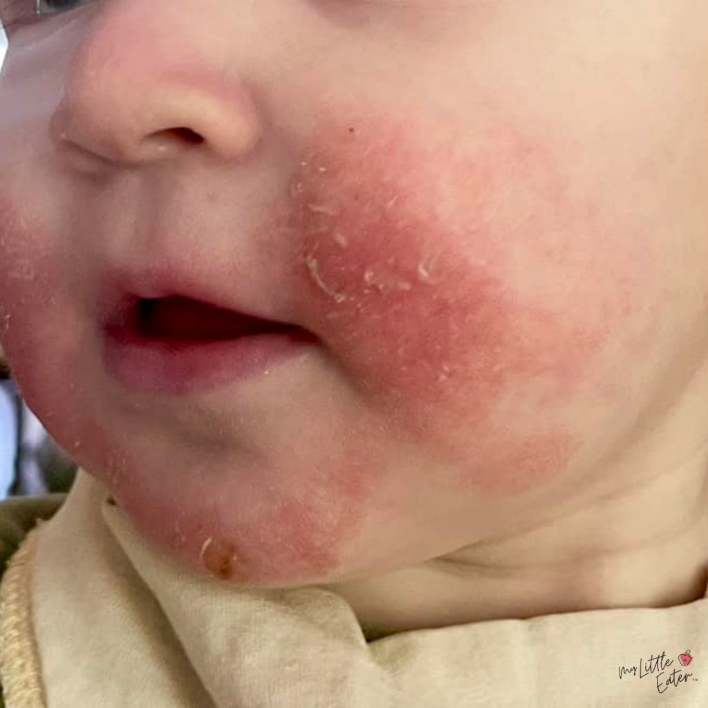 A baby with a scaly red rash on their cheeks and chin from eczema.